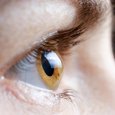 Macro photo of the human eye with corneal disease keratoconus