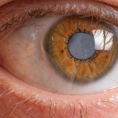 Macro photos of the human eye - cataract clouding of the lens, deterioration of vision. Treatment, surgery and ophthalmology