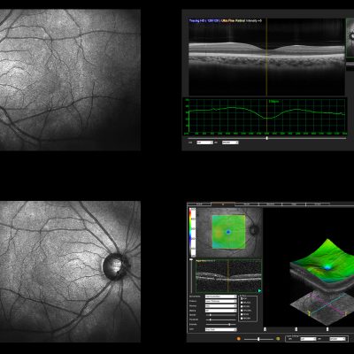 Ophthalmic test - OCT optical coherence tomography measurement. Scan of the macula in retina, layers and thickness of retina.