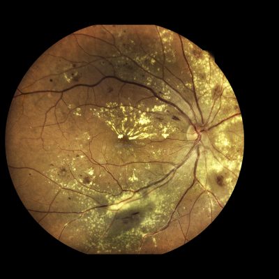 View inside human eye disorders showing retina, optic nerve and macula Severe age-related macular degeneration.Medical image  Retina Abnormal isolated on black  background