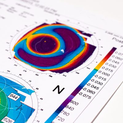 25.07.2020, Zarorizhzhya. Topography of the cornea of the eye, layout. Keratoconus of the right eye is 3rd degree and the left eye is 2 degrees.